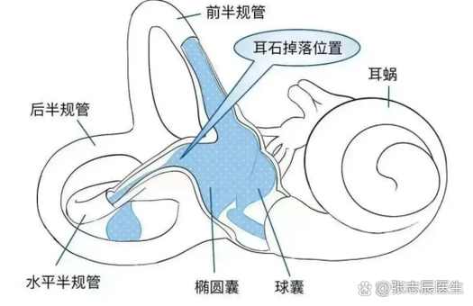 耳石症是什么原因引起的啊