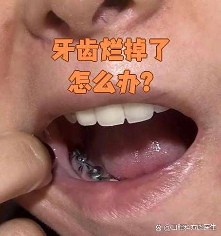 板牙烂了一半是补还是拔掉截图1