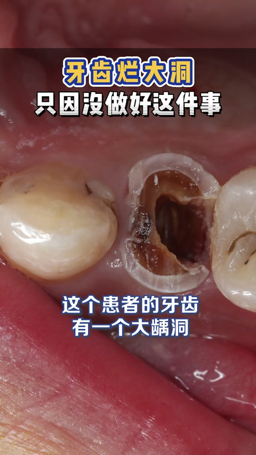 板牙烂了一半是补还是拔掉截图2