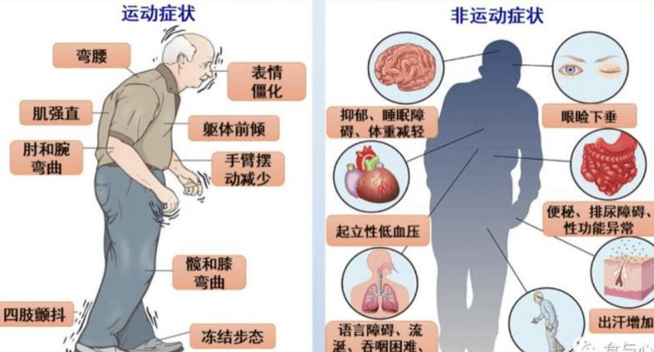 帕金森的前兆是什么症状