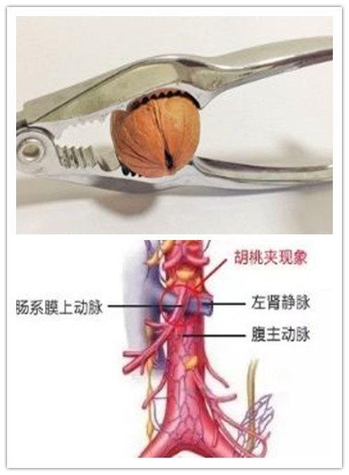 什么情况下是胡桃夹的