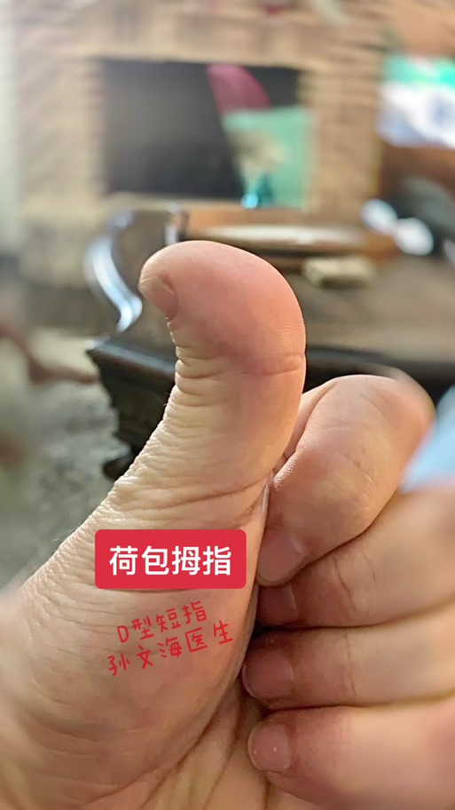 女人大拇指是荷包指头