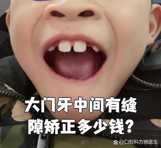 修门牙大概需要多少钱截图3