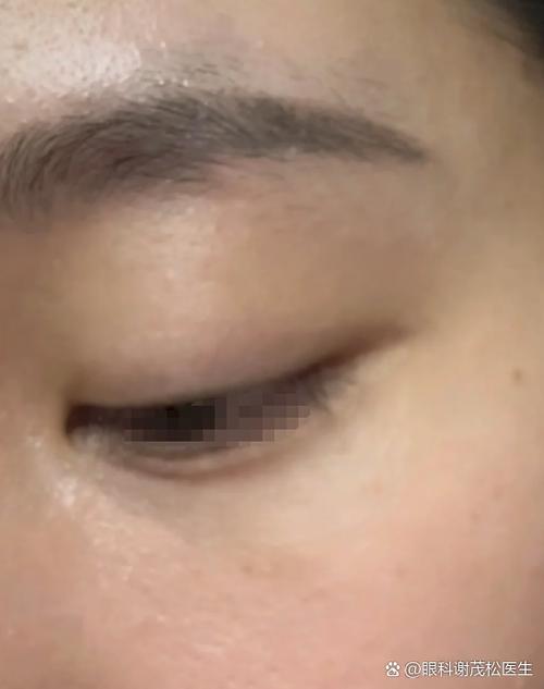 洗衣液进眼里了怎么处理