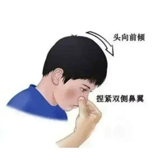 流鼻血处理方式 流鼻血处理方式