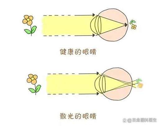 散光手术多大年龄可以做