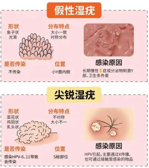 疣的图片与症状