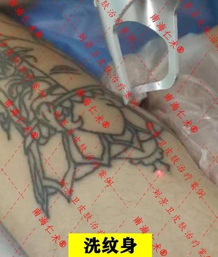 洗纹身最好的医院截图2