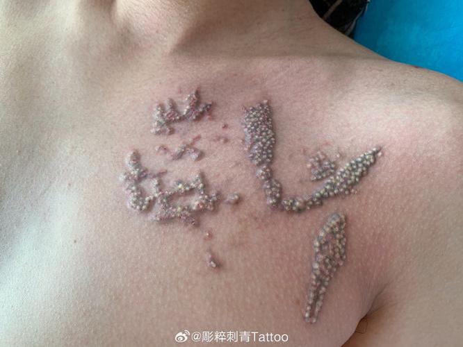 洗纹身最好的医院截图3