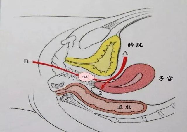 石女可以做手术恢复吗