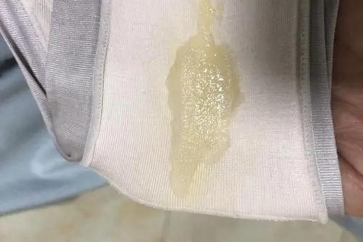 私处排出白色物体