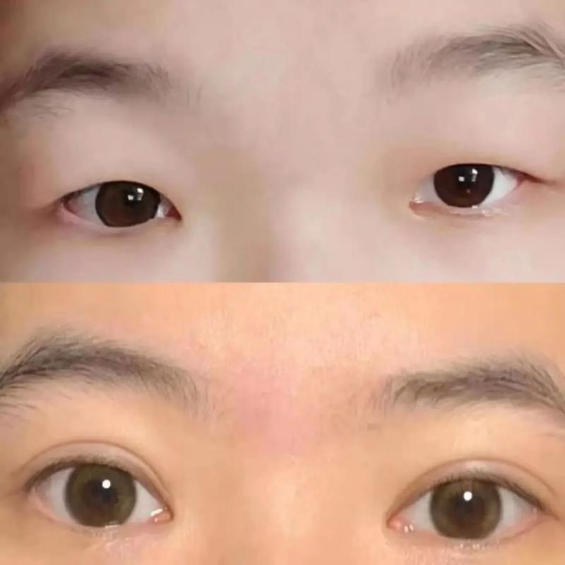一觉醒来单眼皮变双眼皮怎么恢复