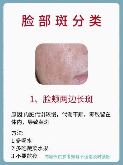 治疗雀斑目前最好的方法