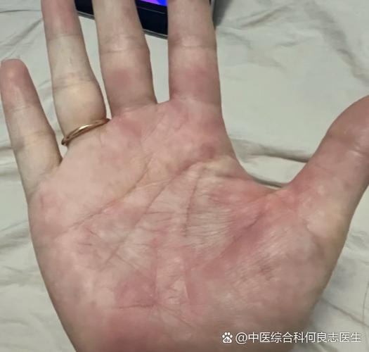 挠手心为什么会痒