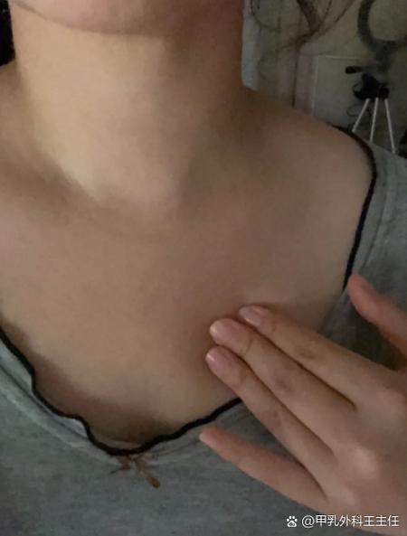 女性左侧胸上方疼痛