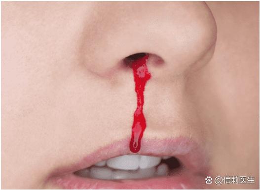 无意识流鼻血怎么回事
