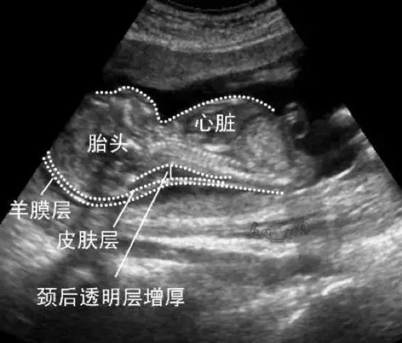 d二聚体孕妇正常值范围