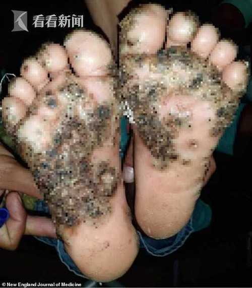 小米蕉被寄生虫寄生截图3