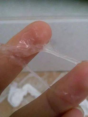 女孩流出白色分泌物