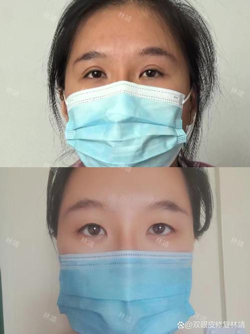 睡一觉起来变成单眼皮