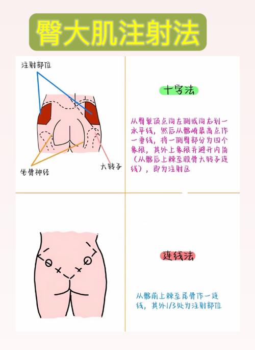 打屁股针怎么打 图解