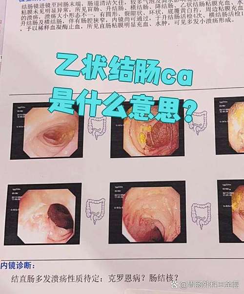 ca是良性还是恶性