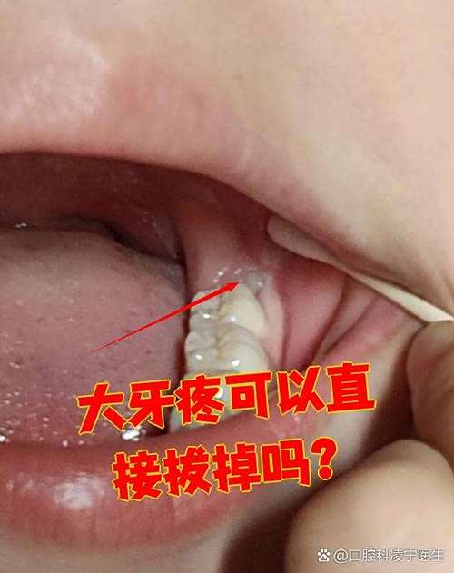 大牙里面又长了一颗牙需要拔掉吗