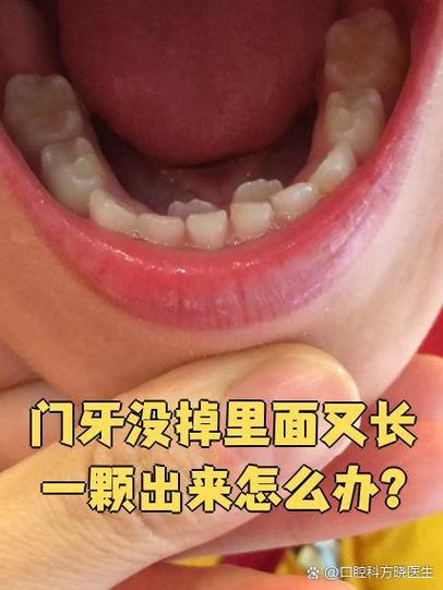 牙齿没掉里面又长一颗歪了截图3