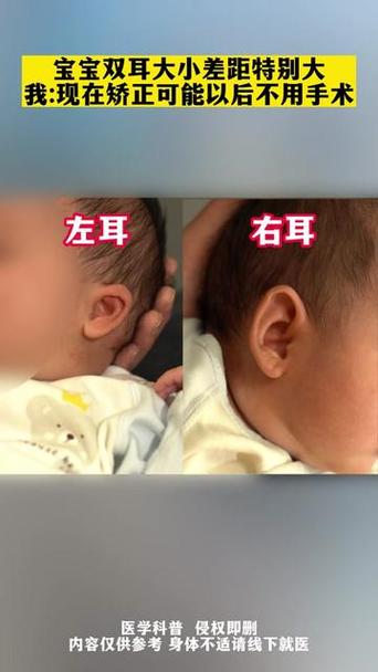耳朵小是什么原因