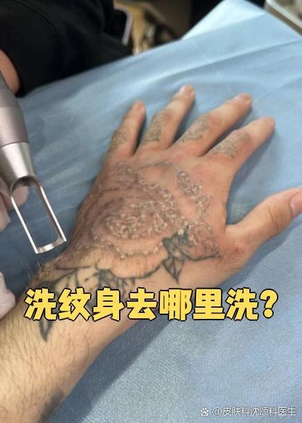 洗纹身去医院挂什么科截图3