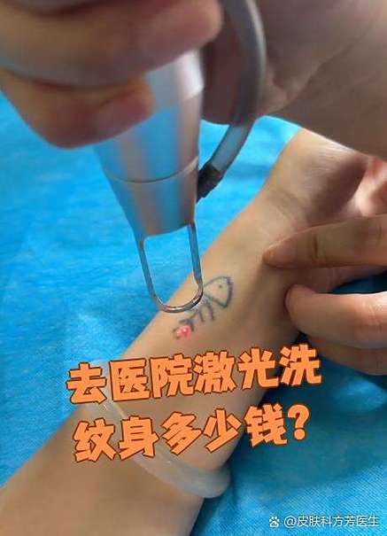 去医院洗纹身多少钱