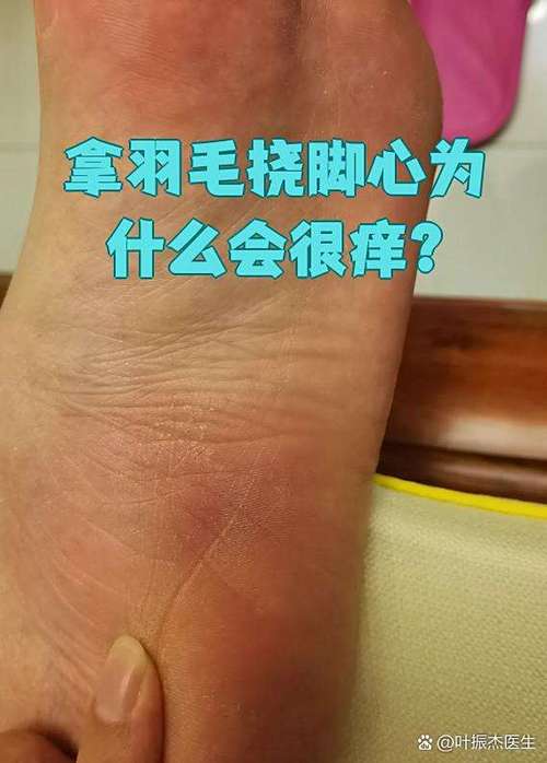 为什么挠脚底板会痒截图3
