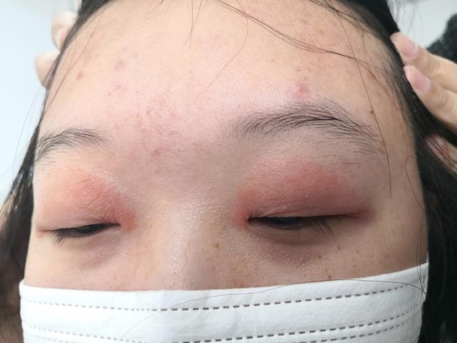 眼皮老是反复过敏红痒