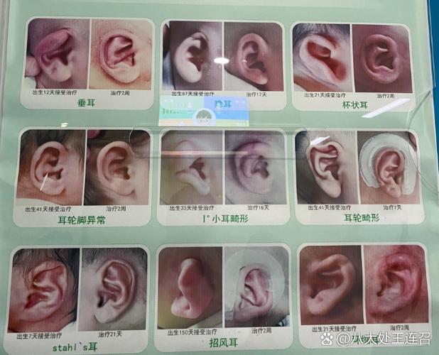 隐耳手术费用多少
