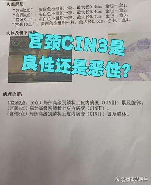宫颈cin3是良性还是恶性