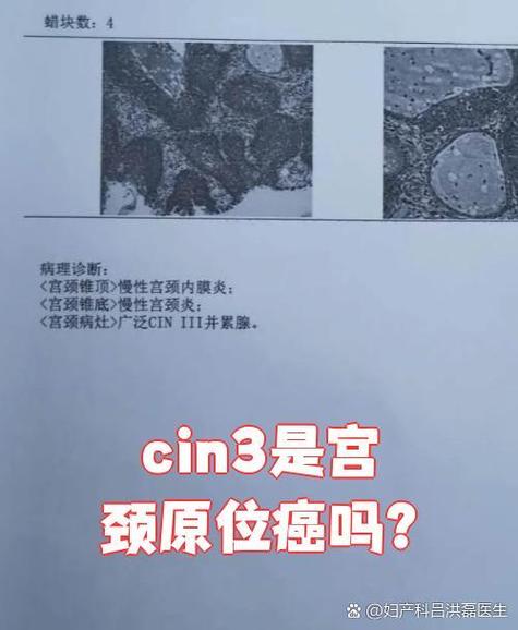 宫颈cin3是良性还是恶性截图3