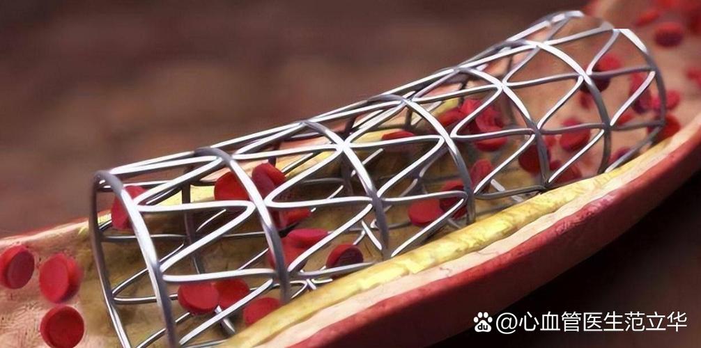 心脏支架坏了可以再换吗