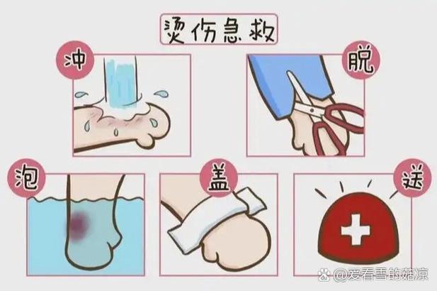 冬天烫伤了是捂着还是晾着