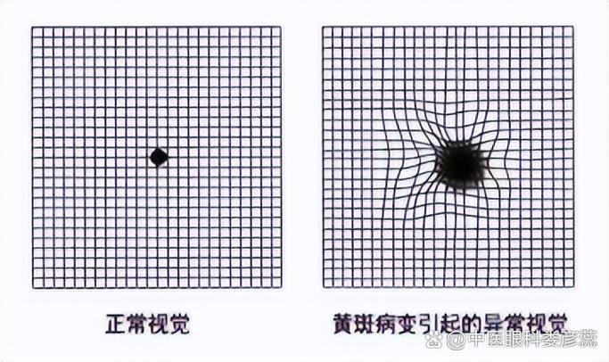 恢复正常视力
