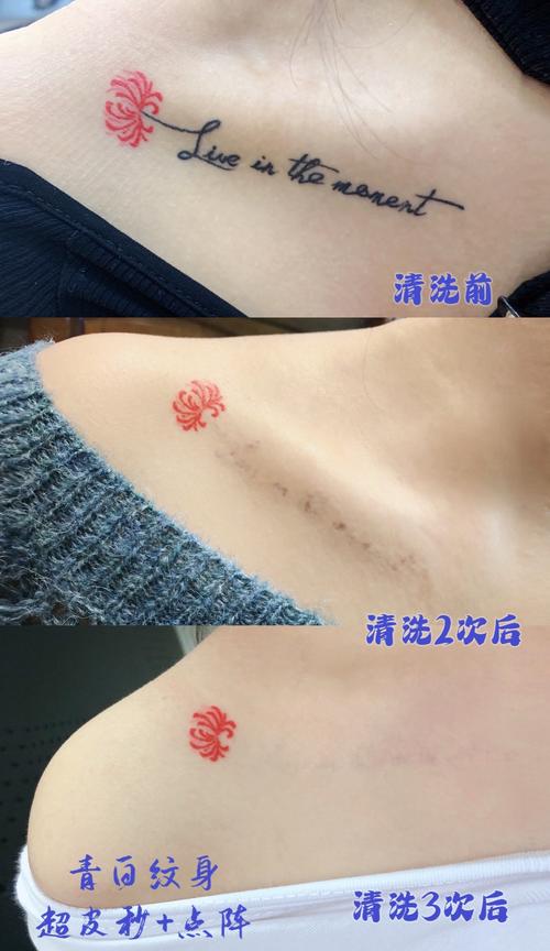 上海去除纹身最好的医院