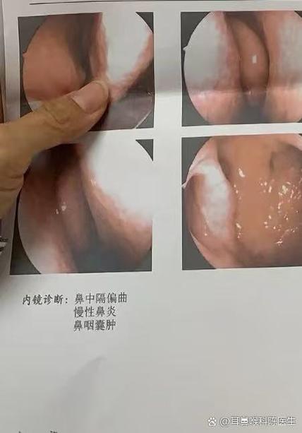 鼻阻隔是什么病