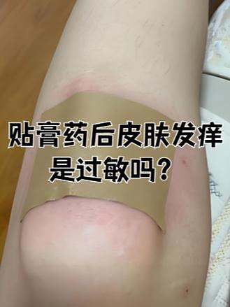怎么去除贴膏药留下的黑药膏