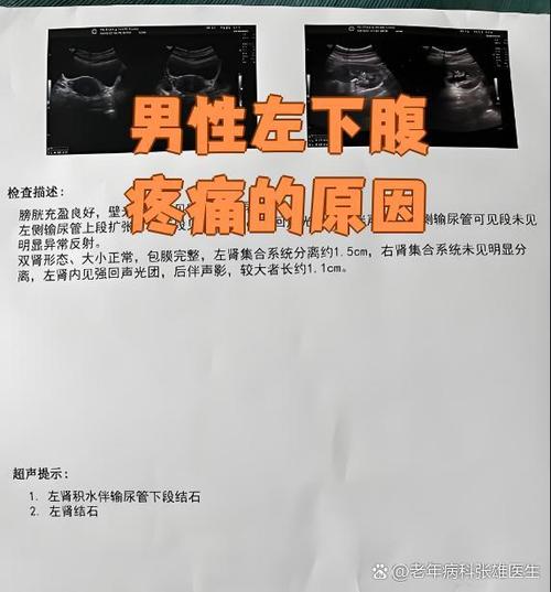男性腹部左下侧疼痛的原因截图3