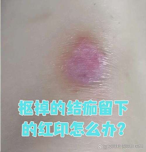 按扣的一半掉下来了怎么修