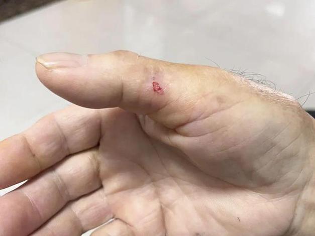 被仓鼠咬过了24小时