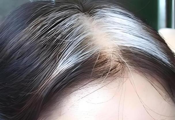 前额鬓角白发截图2