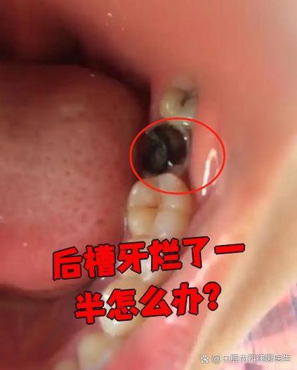 烂了一半的蛀牙要掉了